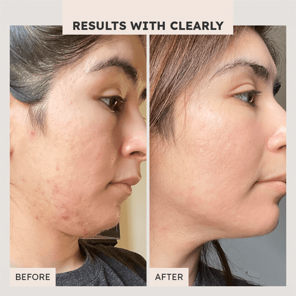 All Clear Advanced Acne System - Clearly Basics